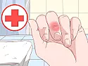 How to Remove a Splinter | &laquo; previous thread