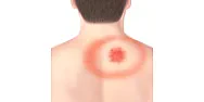 Ticks working in the back yard clearing brush  |  How do you get ticks out of your skin? I keep getting ticks working out in the...