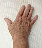 Actinic Keratosis  | &laquo; previous thread