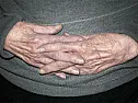 Tips for arthritic repair people  |  Allergic response, may have a high threshold, but once achieved, requires   a...